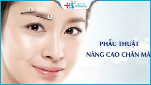 Nâng cung mày giá bao nhiêu tiền? Cách nhận ưu đãi tại BV Hồng Hà