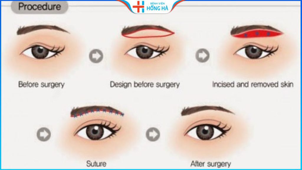 Nâng cung mày bị hỏng biểu hiện như nào? Cách khắc phục hiệu quả