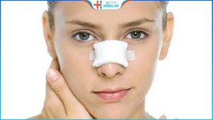 Nâng mũi phải nghỉ dưỡng bao lâu? Cách chăm sóc giúp mũi mau lành