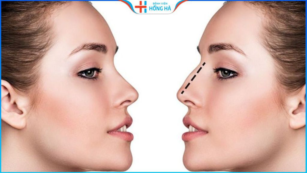 Nâng mũi có an toàn không? Địa chỉ nâng mũi đẹp uy tín tại Hà Nội