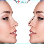 Nâng mũi có an toàn không? Địa chỉ nâng mũi đẹp uy tín tại Hà Nội