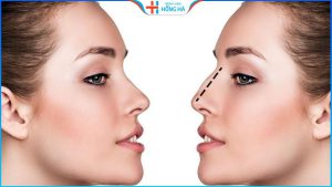 Nâng mũi có an toàn không? Địa chỉ nâng mũi đẹp uy tín tại Hà Nội