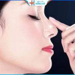 Nâng mũi là tiểu phẫu hay đại phẫu- Chuyên gia BV Hồng Hà giải đáp