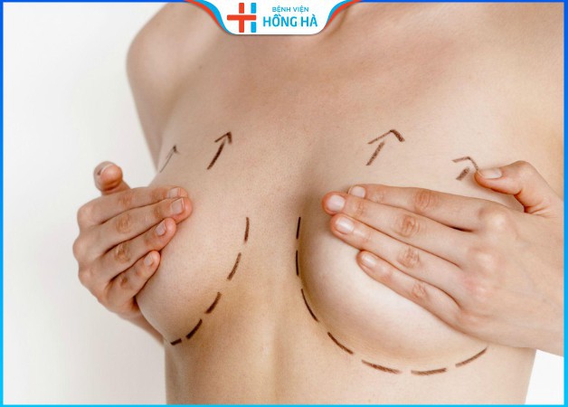phẫu thuật nâng ngực sau sinh khắc phục chảy xệ 