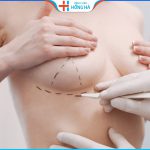 Nâng ngực chảy xệ sau sinh giá bao nhiêu? Tại sao cần nâng vòng 1?