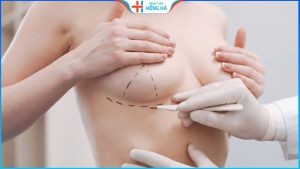 Nâng ngực chảy xệ sau sinh giá bao nhiêu? Tại sao cần nâng vòng 1?