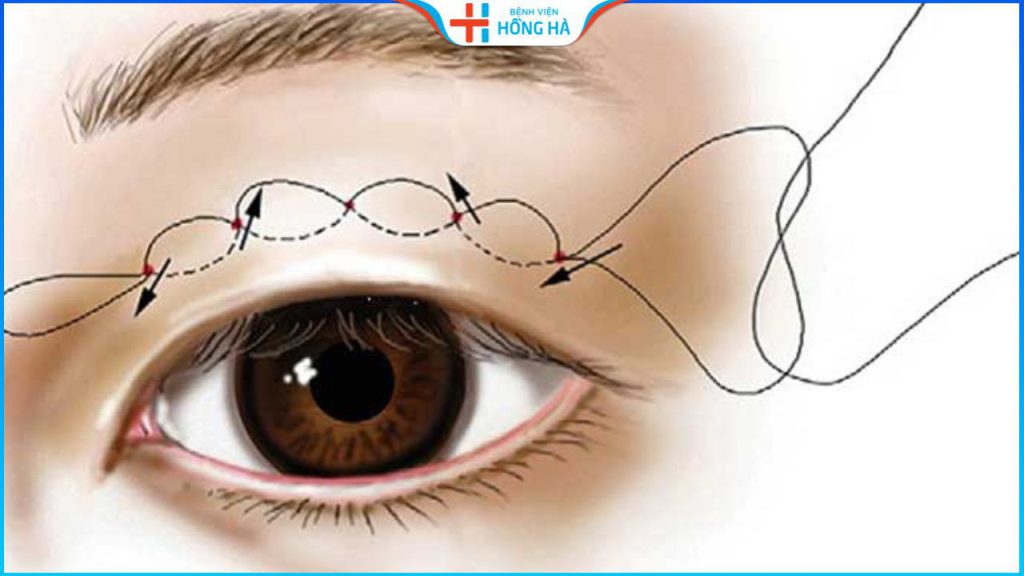 Nhấn mí xong có tháo ra được không? Quy trình tháo nhấn mí thế nào?