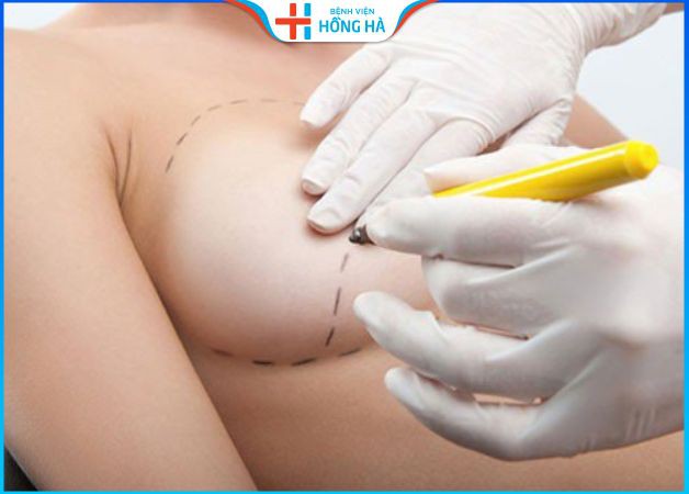 Phẫu thuật nâng ngực ở BV Hồng Hà sử dụng chất liệu độn chính hãng