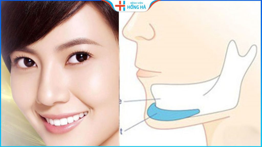 Sụn độn cằm là gì? Điểm danh các loại sụn độn cằm phổ biến nhất