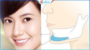 Sụn độn cằm là gì? Điểm danh các loại sụn độn cằm phổ biến nhất