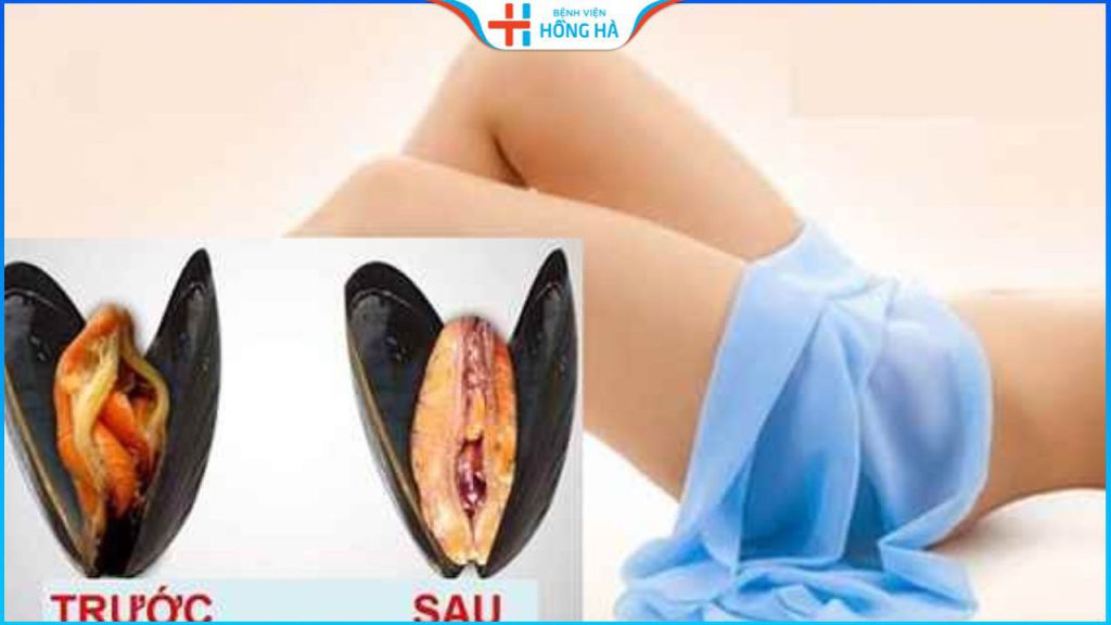 Thẩm mỹ vùng kín là gì? 3 phương pháp thẩm mỹ vùng kín hiện đại nhất