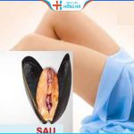 Thẩm mỹ vùng kín là gì? 3 phương pháp thẩm mỹ vùng kín hiện đại nhất