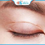 Thời gian cắt mí sau bao lâu đẹp tự nhiên? Chăm sóc đúng cách