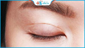 Thời gian cắt mí sau bao lâu đẹp tự nhiên? Chăm sóc đúng cách