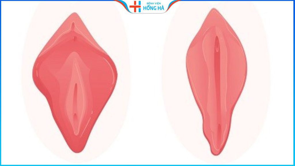 Thu nhỏ môi bé giá bao nhiêu? Bảng giá thu môi bé tại BV Hồng Hà