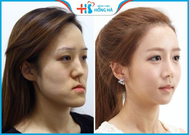 Chỉnh hình phẫu thuật khuôn mặt khắc phục mặt lưỡi cày