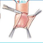 Cắt hẹp bao quy đầu bao nhiêu tiền – Cập nhập mới nhất 2023