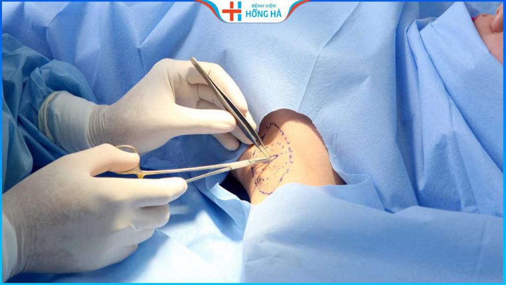 Cắt tuyến mồ hôi nách: Những nguy cơ tiềm ẩn bạn có biết?