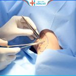 Cắt tuyến mồ hôi nách: Những nguy cơ tiềm ẩn bạn có biết?