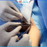 Cắt tuyến mồ hôi nách giá bao nhiêu? Cách nhận ưu đãi tại Hồng Hà