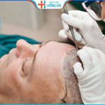 Cấy tóc tự thân có hiệu quả không? Các phương pháp phổ biến