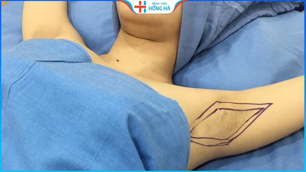 Chi phí hút nội soi tuyến mồ hôi nách tận gốc tại Hồng Hà