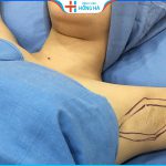 Chi phí hút nội soi tuyến mồ hôi nách tận gốc tại Hồng Hà