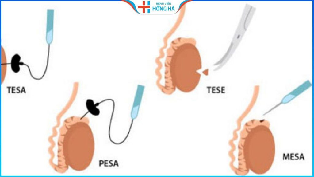 Phương pháp chọc hút tinh trùng – Điều trị vô sinh nam giới hiệu quả đến 95%