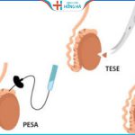 Phương pháp chọc hút tinh trùng – Điều trị vô sinh nam giới hiệu quả đến 95%