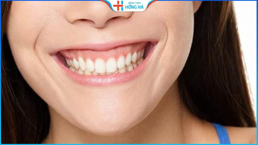 Phẫu thuật cười hở lợi: Giải pháp hiệu quả lấy lại nụ cười rạng rỡ