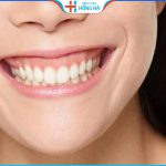 Phẫu thuật cười hở lợi: Giải pháp hiệu quả lấy lại nụ cười rạng rỡ