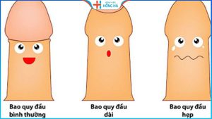 Hẹp bao quy đầu ở nam giới: Nguyên nhân và 4 phương pháp điều trị hiệu quả