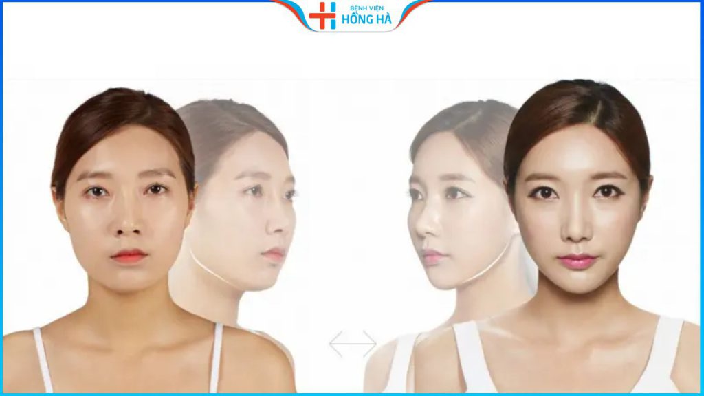 Gọt hàm có ảnh hưởng về sau không? Có đau như lời đồn?