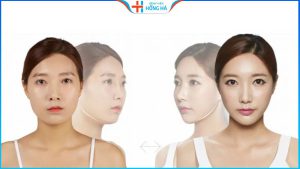 Gọt hàm có ảnh hưởng về sau không? Có đau như lời đồn?