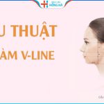 Gọt hàm giá bao nhiêu? 4 yếu tố ảnh hưởng chi phí gọt hàm