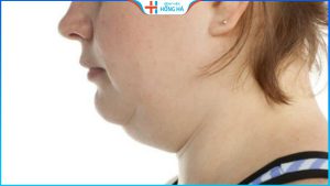 Đặc điểm của hai cằm? Bí ẩn tướng số và cách khắc phục cằm 2 ngấn