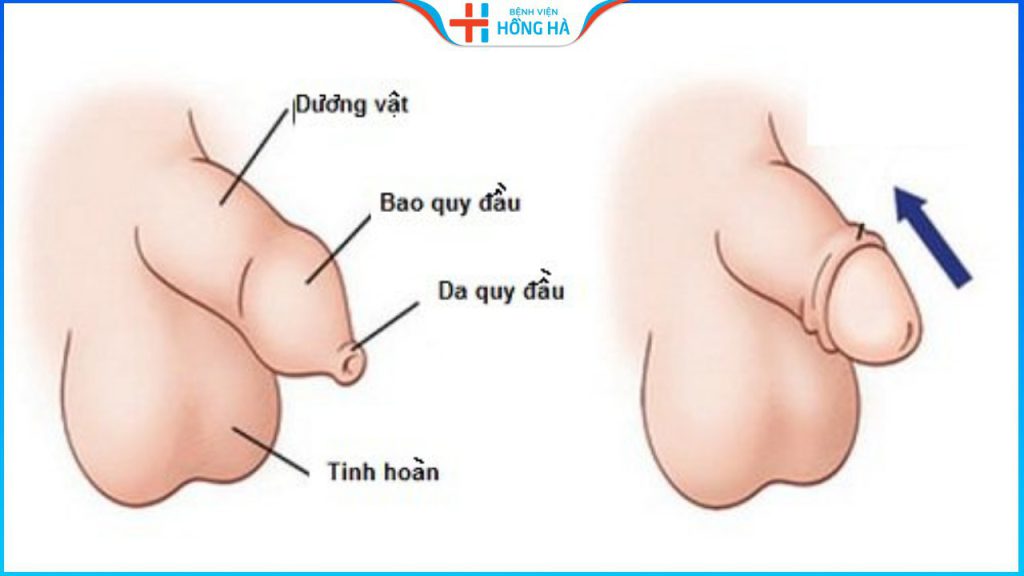 Hẹp bao quy đầu: Nguyên nhân, triệu chứng và cách điều trị hiệu quả