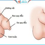 Hẹp bao quy đầu: Nguyên nhân, triệu chứng và cách điều trị hiệu quả