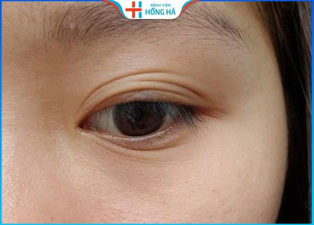 Mắt 3 mí có đẹp không? Nhân tướng học nói lên điều gì