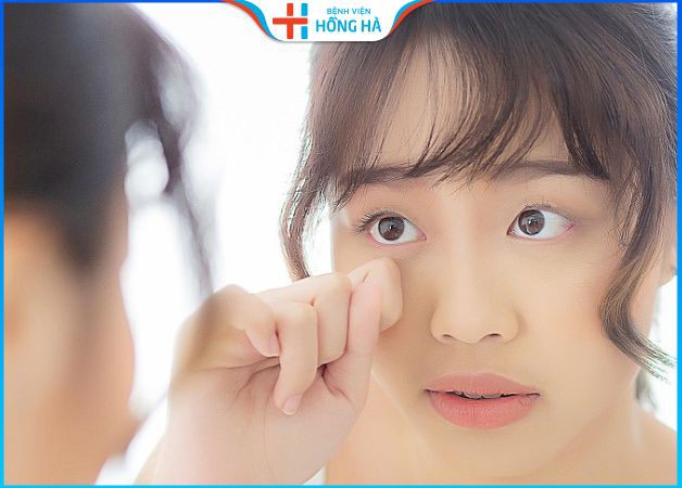 Mắt lé kim là như thế nào? 4 cách khắc phục mắt lé thành mắt 2 mí to đẹp