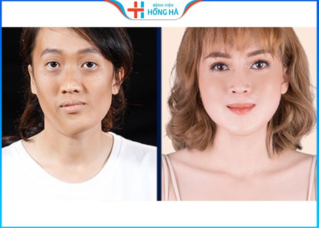 Khách hàng thành công cải thiện khuôn mặt mất cân đối tại BV Hồng Hà
