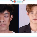Mặt lệch là như thế nào? 6 Nguyên nhân và cách khắc phục