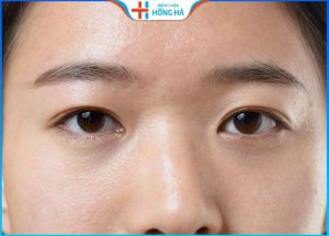 Mí lót: Đặc điểm nhận dạng, khắc phục mí lót thành 2 mí đẹp an toàn