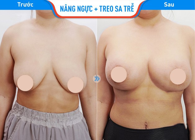 Hình ảnh trước và sau khi nâng ngực của bà mẹ 2 con tại BV Hồng Hà