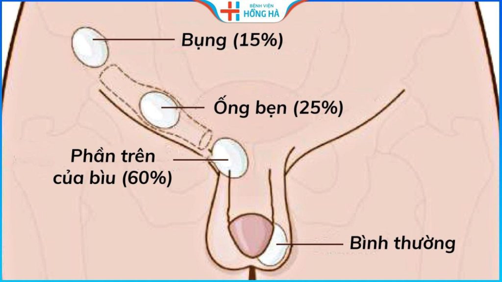 Phẫu thuật tinh hoàn ẩn: Cải thiện sức khỏe tới 85% bệnh nhân nam giới