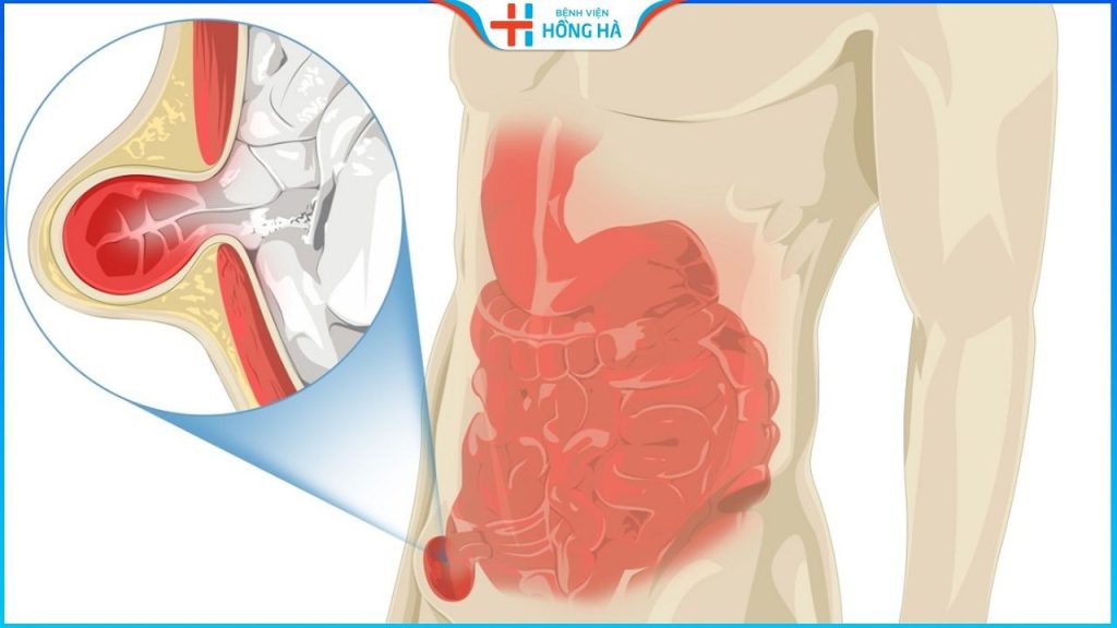 Thoát vị bẹn: Nguyên nhân, triệu chứng và cách khắc phục hiệu quả 85%