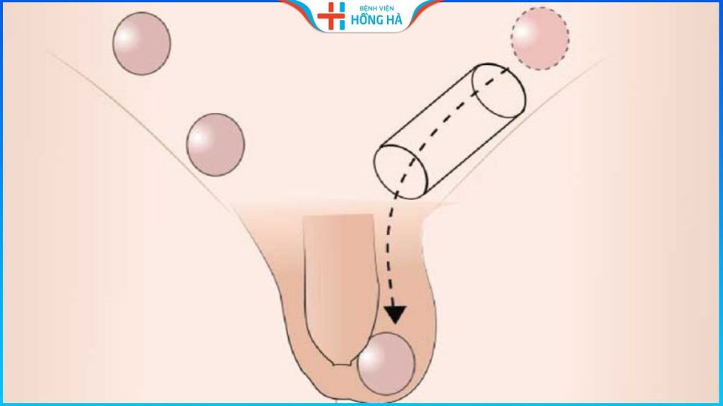 Phẫu thuật tinh hoàn lạc chỗ: Tỷ lệ thành công đặt lại vị trí trên 80%