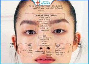 Vị trí mọc mụn nói lên điều gì? Cách trị mụn an toàn, hiệu quả