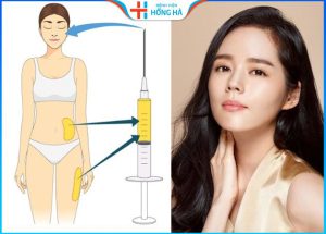 Độn cằm bằng mỡ tự thân: 5 ưu điểm nổi bật, bạn khó lòng bỏ qua