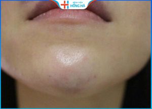 5 biến chứng độn cằm sau phẫu thuật và 2 lưu ý phòng tránh hiệu quả